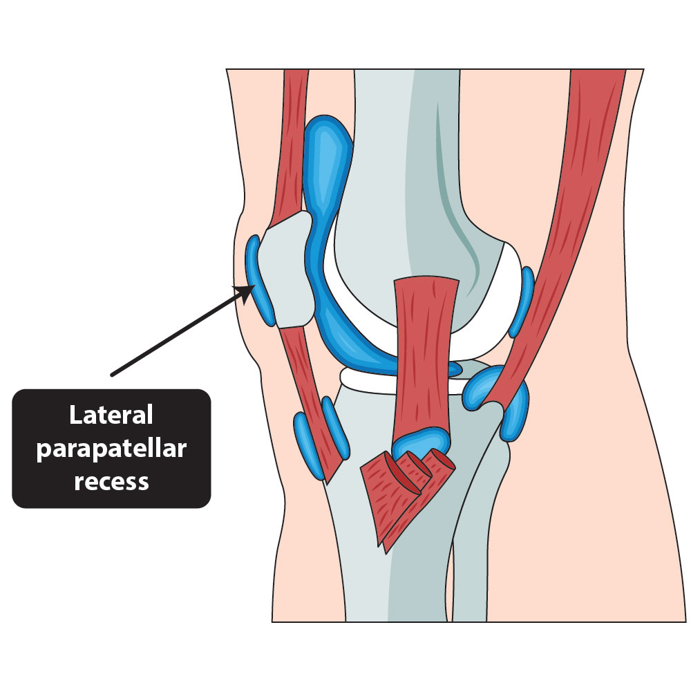 The-Knees_Lateral-parapatellar-recess