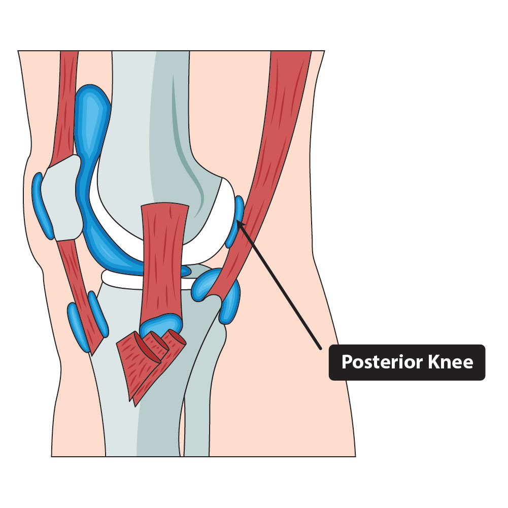 The-Knees_Posterior-knee-(Bakers-cyst)