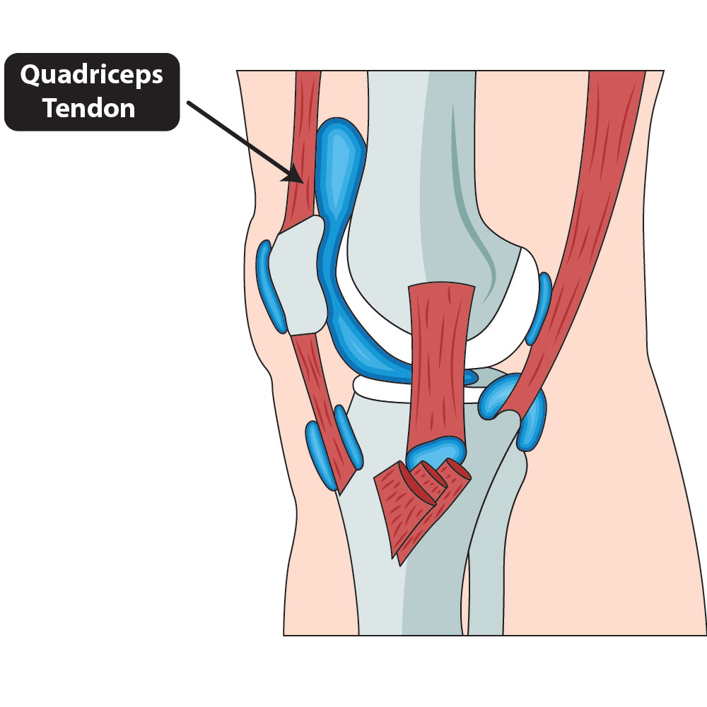 The-Knees_quadriceps-tendon-