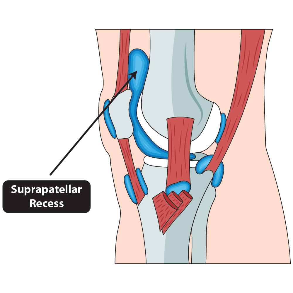 The-Knees_suprapatellar-recess